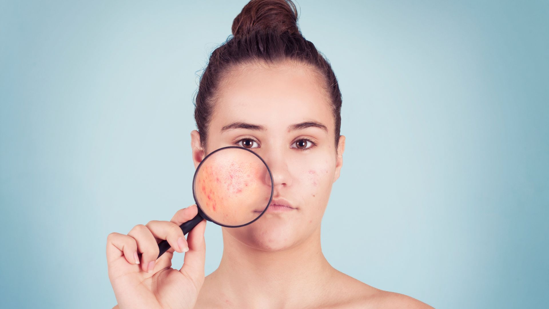 Trattamento delle cicatrici da acne