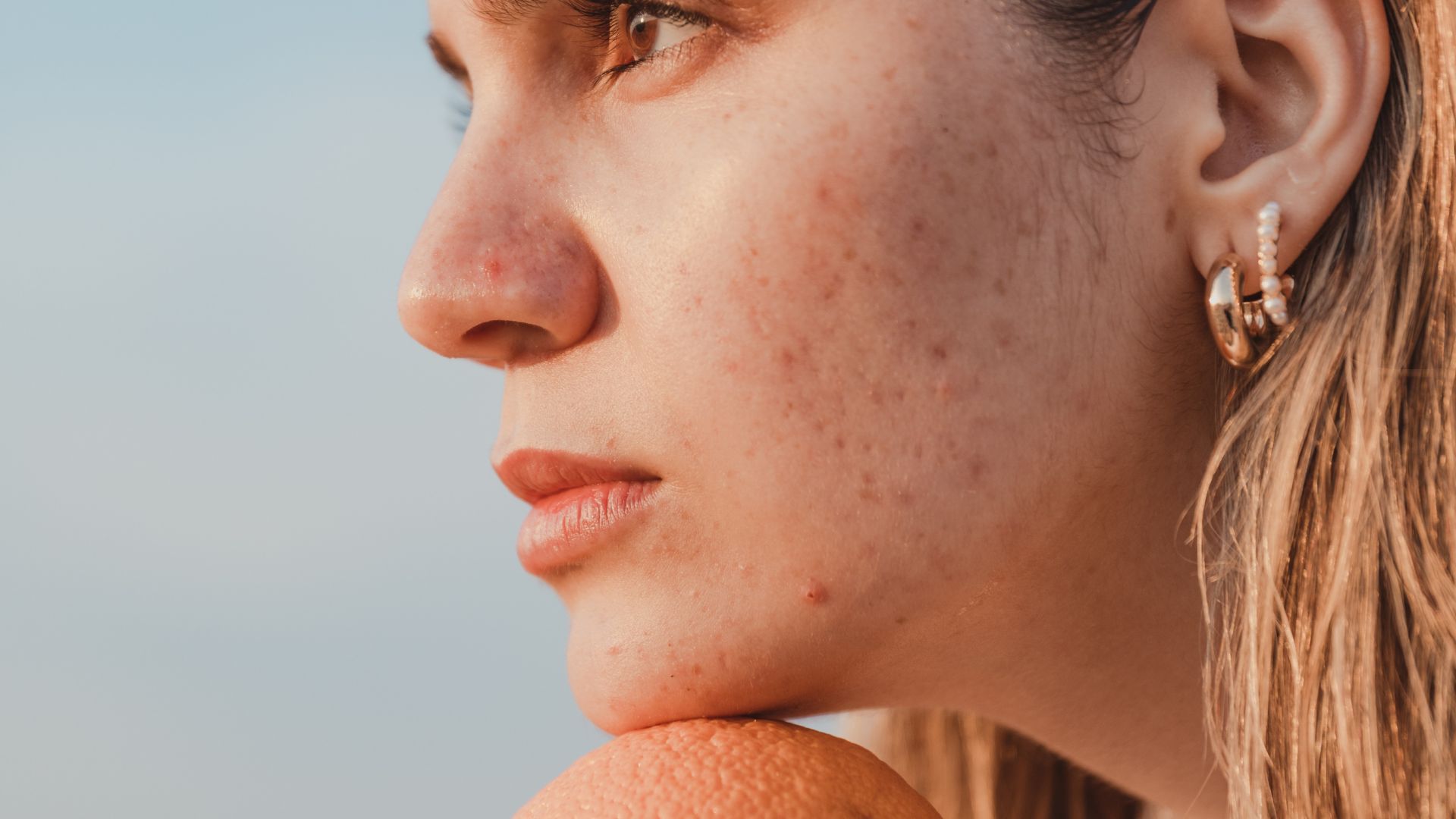 Pelle con segni post-acne da uniformare